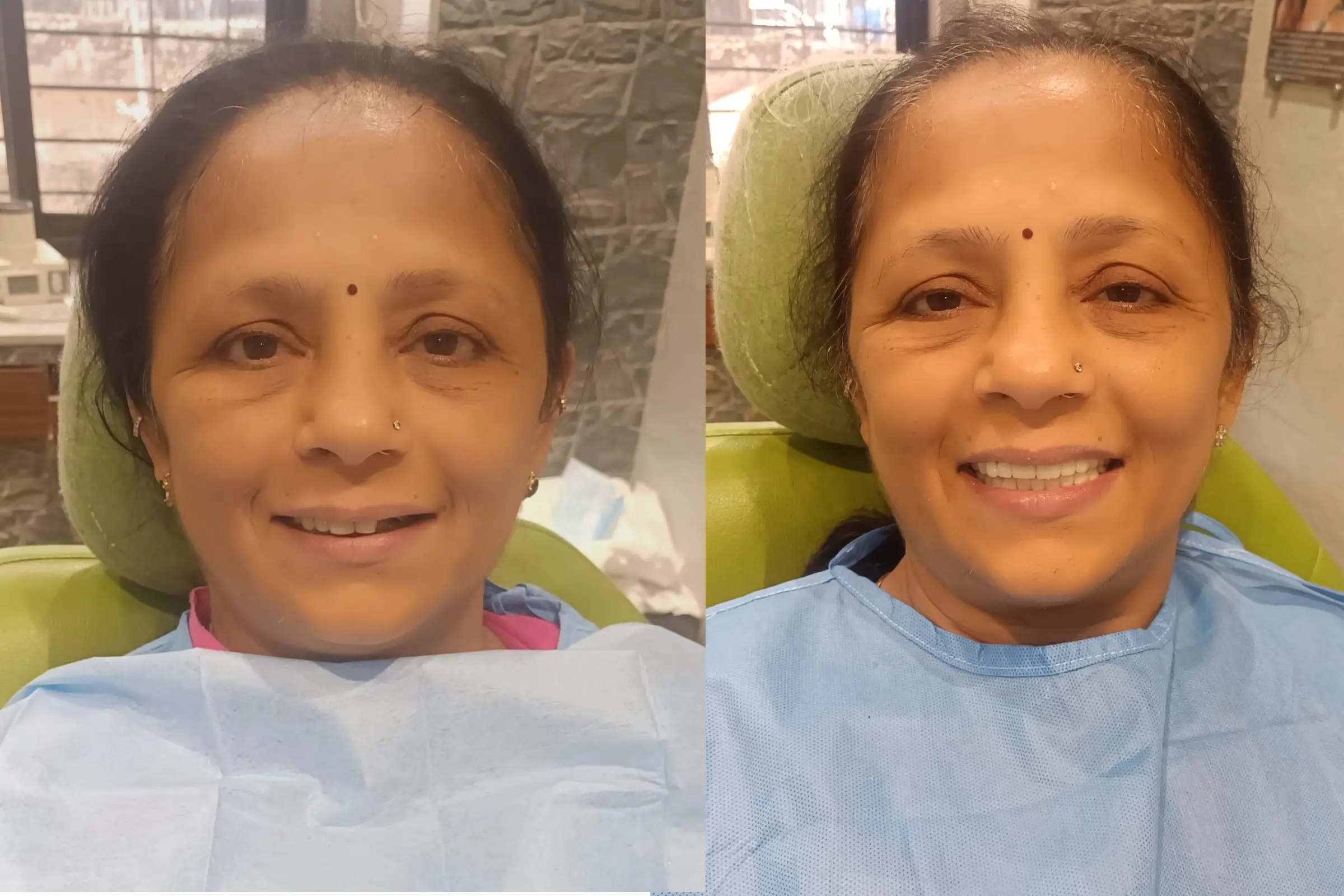 Dental Impant 1