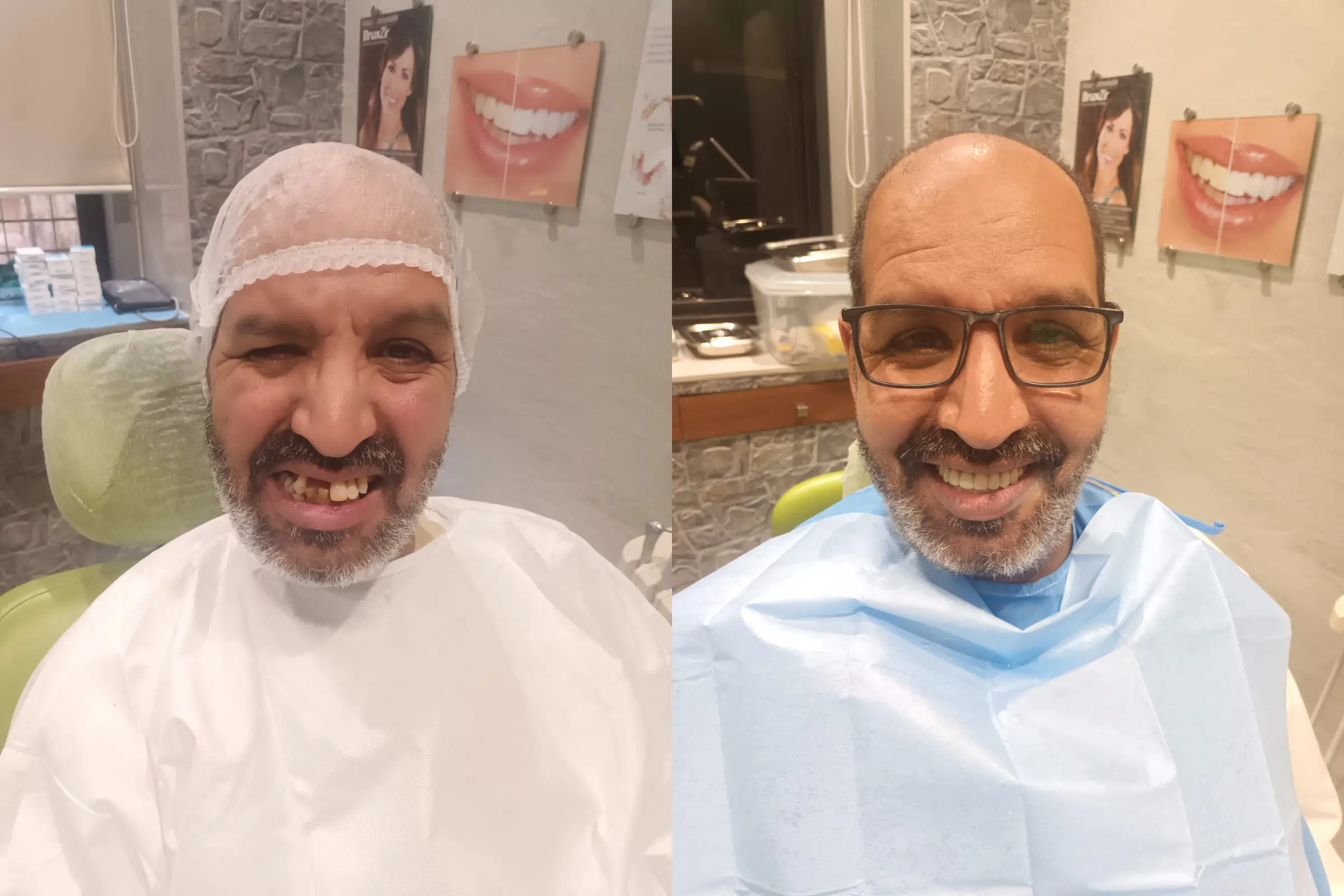 Dental Impant 2