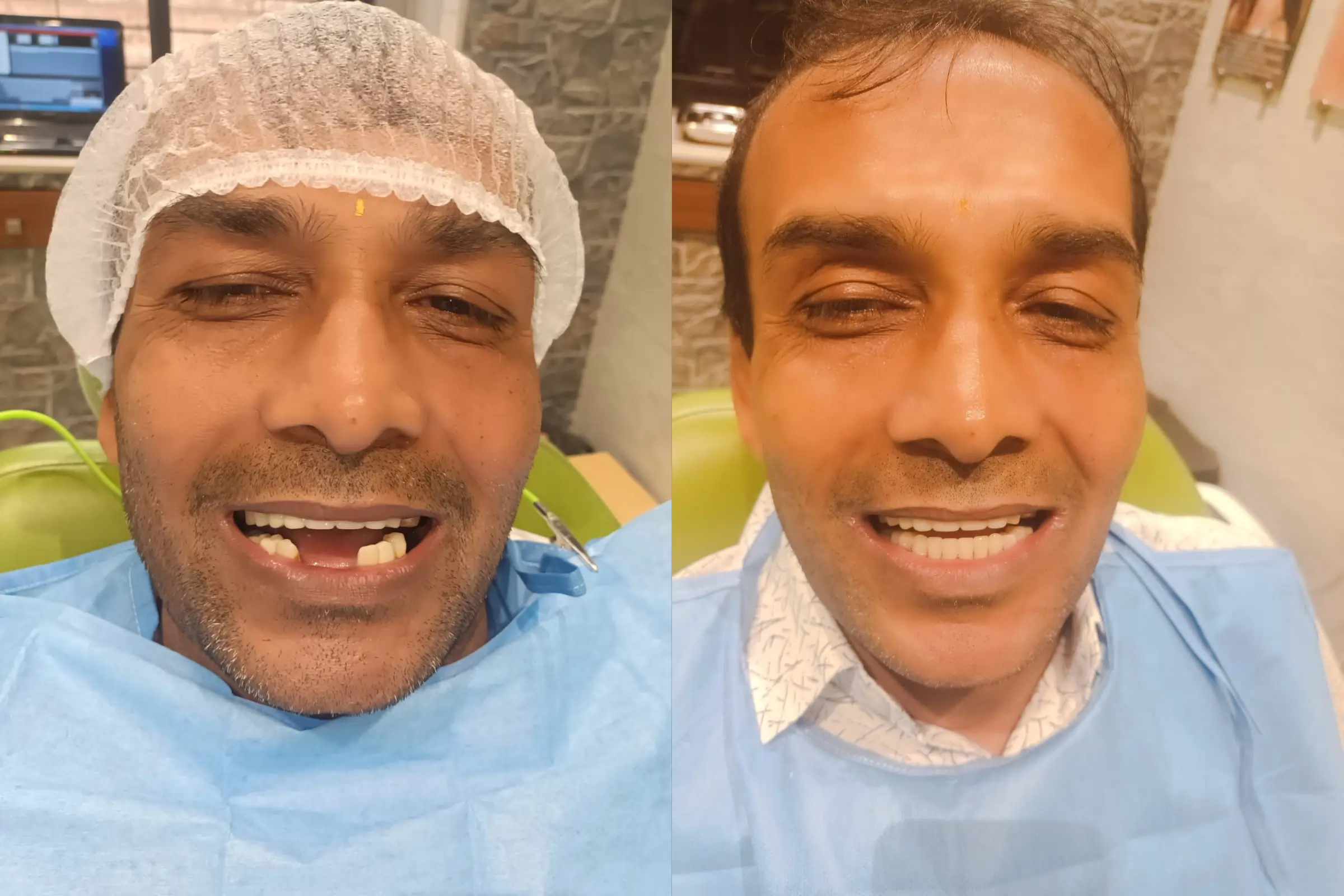 Dental Impant 3